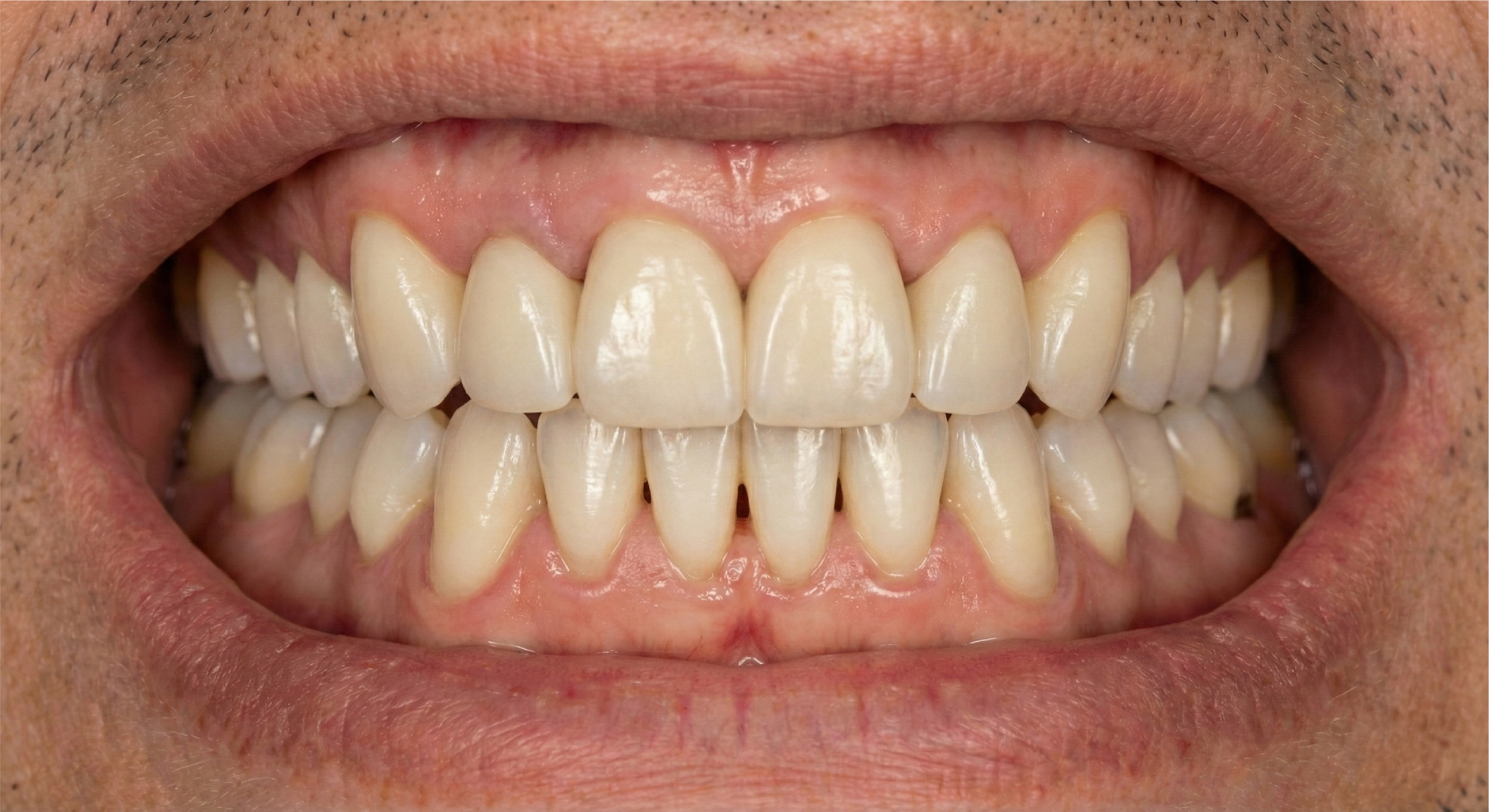 After — Full Mouth Rehabilitation